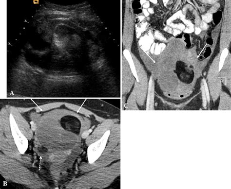 Torsion Of A Left Ovarian Mature Cystic Teratoma A Year Old Female My