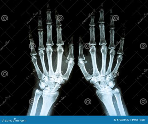 Film X Ray Of Rheumatoid Arthritis Hand Shows Joint Space Narrowing Of