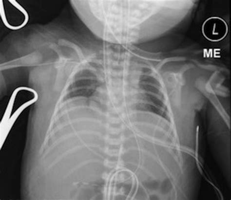 Cureus Infant With Clinical Evidence Of Pulmonary Hypoplasia A Case