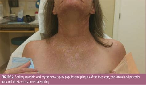 Figure From Lupus Erythematosus Lichen Planus Overlap Syndrome