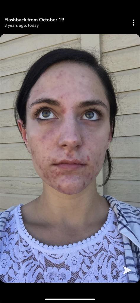 My Before And After Accutane Acne