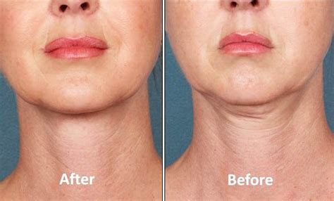 Get Rid Of Double Chin With Botox Treatment At Rs 20000box In Chennai