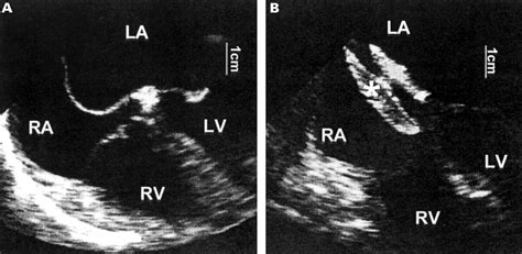 Morphology Of Perforated Atrial Septal Aneurysm Suitable For Closure By