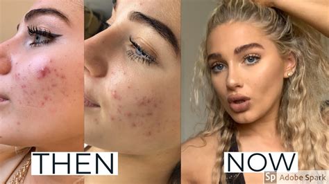 How I Cleared My Acne Within Days Chemical Peel Review Youtube