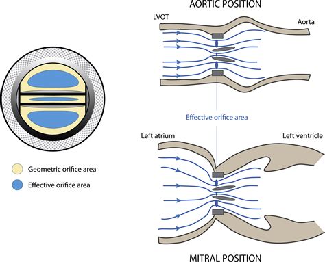 Effective Orifice Area During Exercise In Bileaflet Mechanical Valve