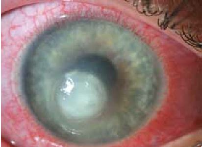 Evans, minjian ni, brigitte a. Pseudomonas keratitis | Download Scientific Diagram