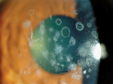 Anterior Basement Membrane Dystrophy Of The Cornea Picture Of