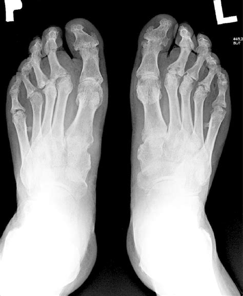 X Ray Of Feet The Destructive Form Of Psoriatic Arthritis Arthritis
