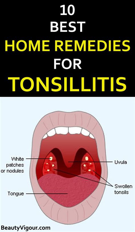 10 Best Home Remedies For Tonsillitis Tonsilitis Remedy Remedies