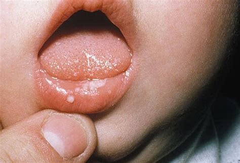 These infections are quite common and often cause an irritating rash. Picture Of Baby Yeast Infections Picture Image on RxList.com