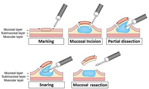 Reduction In The Procedure Time Of Hybrid Endoscopic Submucosal