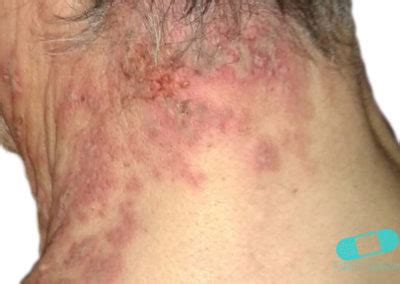Man kan bara få bältros om man haft vattkoppor tidigare. Bältros (herpes zoster)