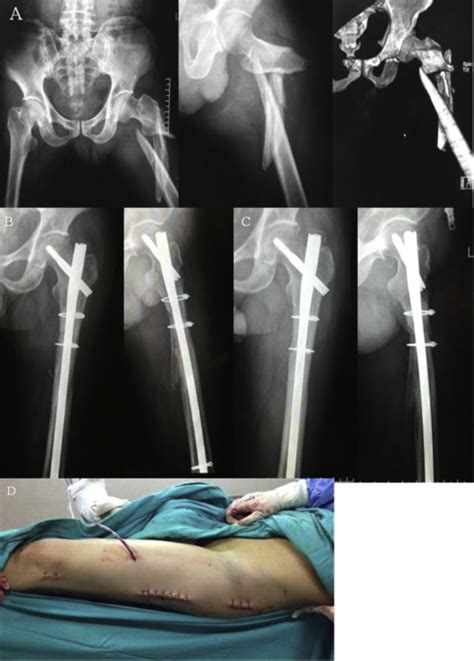 Proximal Femur Fracture