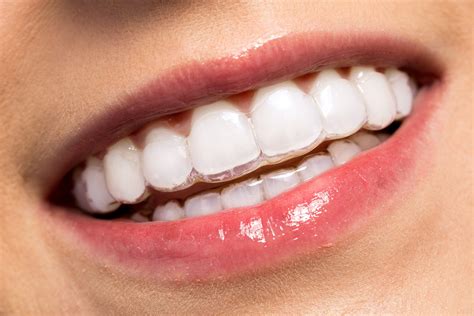 Invisalign La Ortodoncia Invisible De La Que Todos Hablan Dentalbell Riset