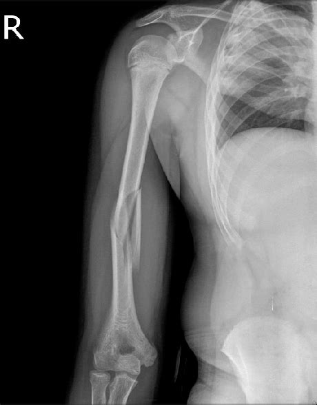 Distal Humeral Shaft Fracture