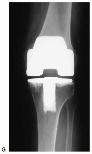 Genu Recurvatum In Total Knee Arthroplasty Musculoskeletal Key