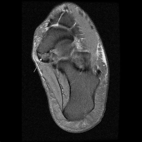 The muscles acting on the foot can be divided into two distinct groups; Accessory navicular as a cause of medial foot pain:Evaluation with MRI | Eurorad