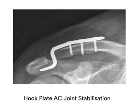 Ac Joint Stabilisation Shoulder Surgery Sydney Shoulder Unit
