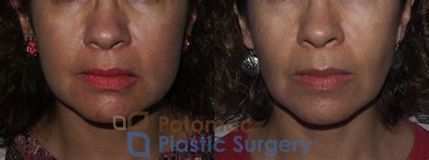 Buccal Fat Reduction To Slim The Cheeks Of A Middle Aged Woman