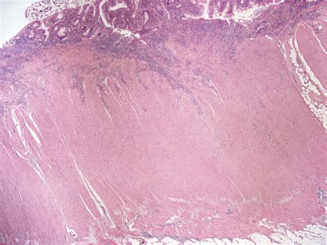 Pathology Outlines Inflammatory Bowel Disease Indeterminate Type