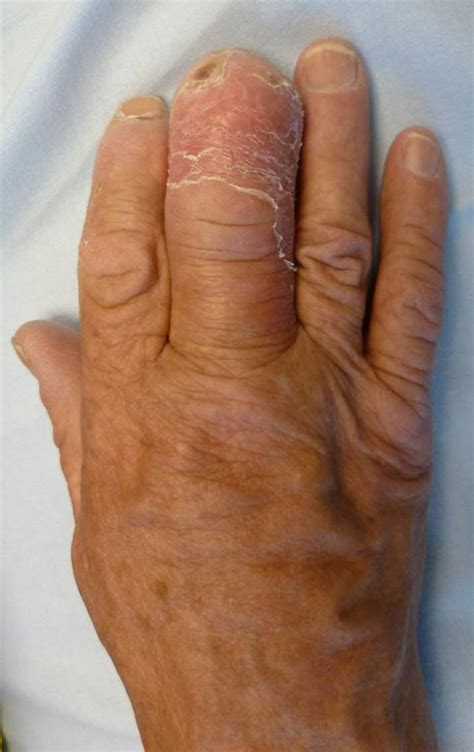 Purulent Infection In The Third Finger With Associated Osteomyelitis