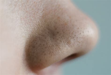 Clogged Pores Home Remedies And Treatment Options