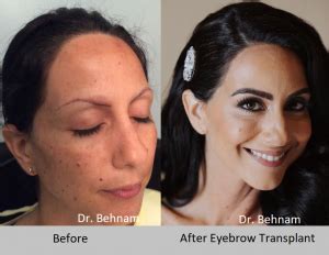 I would like to invite you to take the time to explore our website to learn about our fine products, and how you can benefit from our affordable hair replacement services. Eyebrow transplant Los Angeles