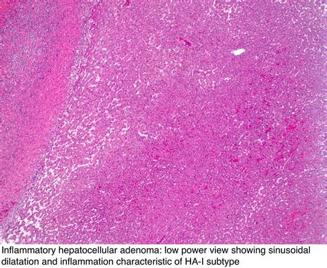 Pathology Outlines Hepatocellular Adenoma