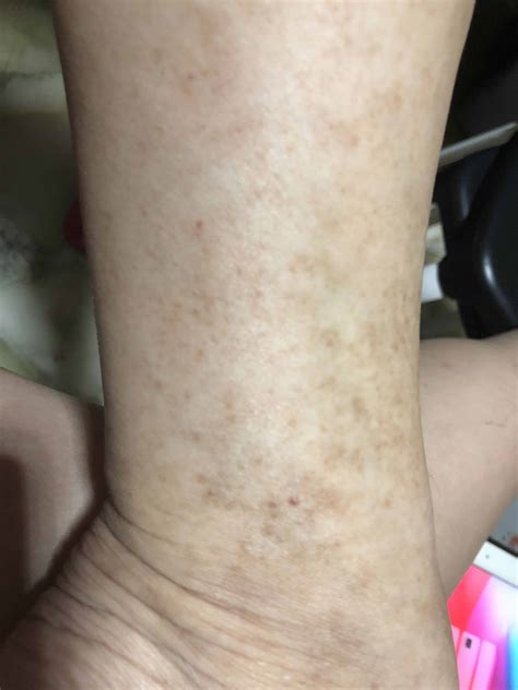 Light Brown Spots Appearing On Skin