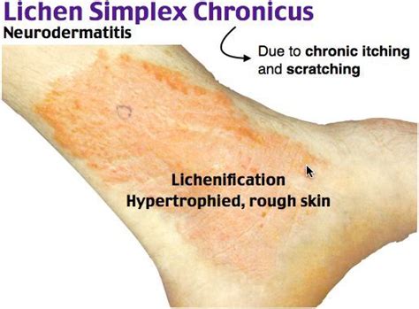 lichen simplex chronicus neurodermatitis