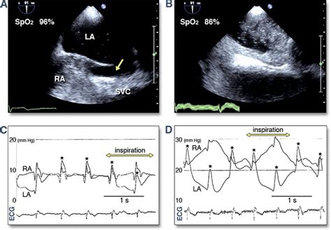 Platypnea Orthodeoxia Syndrome Due To Pfo And Aortic Dilation Jacc