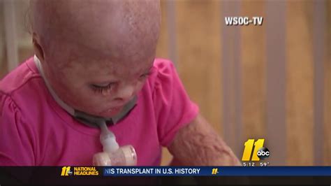Mother Of 1 Year Old Burned In Explosion Speaks About Girls Recovery Abc11 Raleigh Durham