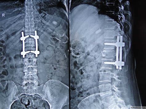Spine Fractures Pptx D Haider Muhadharaty