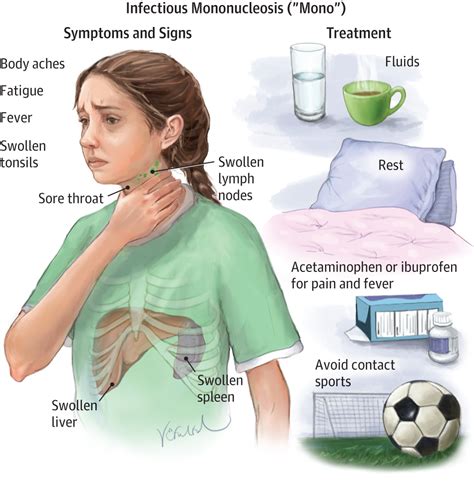 Symptoms Of Mono In Children