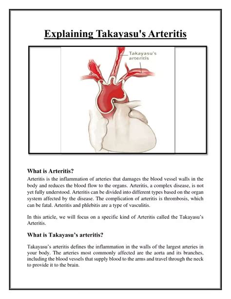 Ppt Explaining Takayasus Arteritis Powerpoint Presentation Free