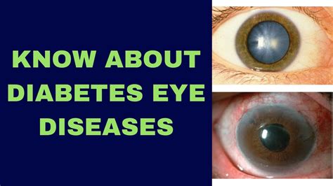 Diabetic Eye Disease Youtube