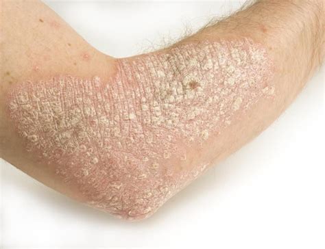 Pictures Of Skin Rashes Lovetoknow Treat Psoriasis Psoriasis Cure