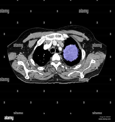 Abnormal Lung Ct Hi Res Stock Photography And Images Alamy