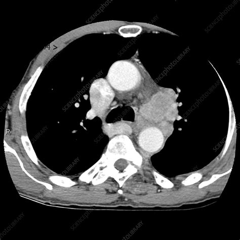 A ct scan can help to diagnose lung cancer. Metastatic Lung Cancer (CT Scan) - Stock Image - C027/0908 ...