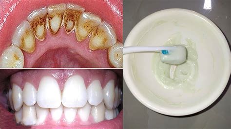 How To Remove Dental Plaque In 2 Minutes With Just These 3 Natural