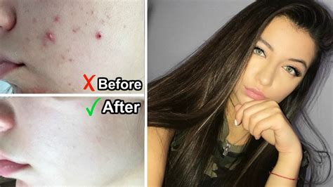 How I Cleared My Acne In 1 Week Progress Pictures Youtube