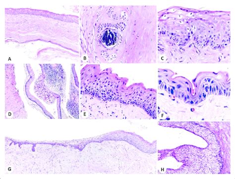 Variations Of Keratocystic Odontogenic Tumor Kcot Histopathological