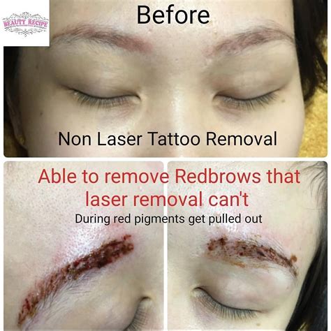 Eyebrow Tattoo Removal Healing Process