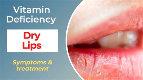 Ouch My Lips Vitamin Deficiency Sucks Tips Pls — Eating Enlightenment