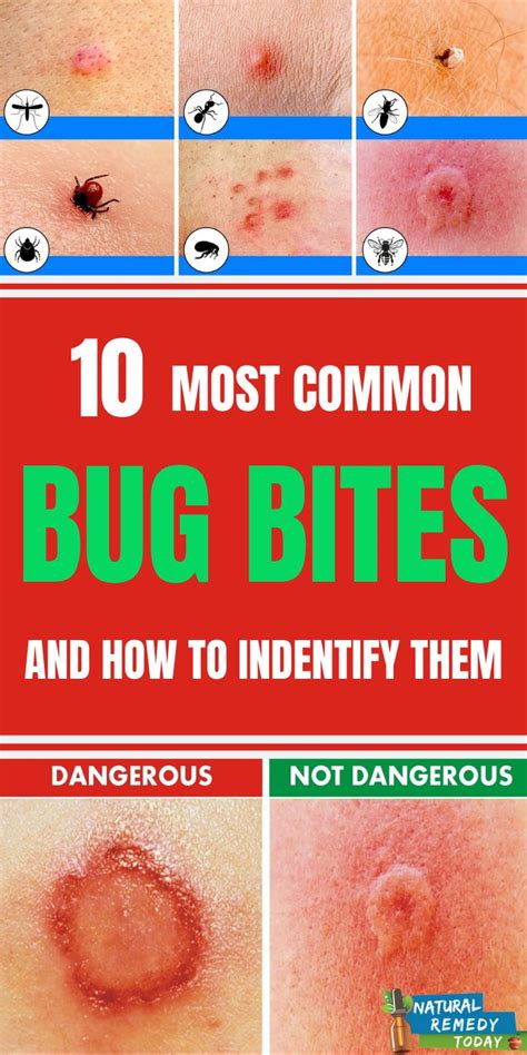 10 Bug Bites Anyone Should Be Able To Identify In 2020 Bug Bites