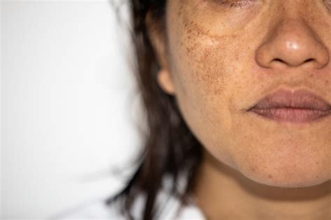Common Dermatological Conditions In Skin Of Colour The Pharmaceutical