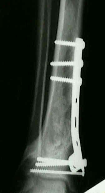 Plate Fixation Of Pilon Fractures Wheeless Textbook Of Orthopaedics