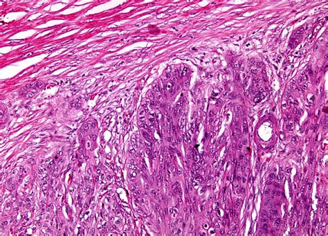 Esophageal Carcinoma At 10x Magnification Nikons Microscopyu
