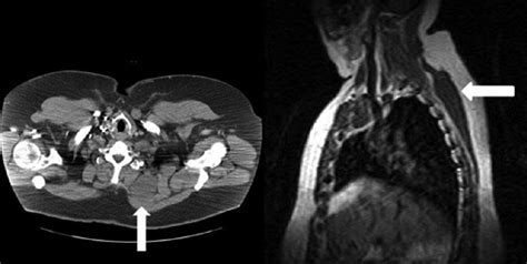 Left Chest Ct Scan Shows The Large Cystic Mass Arrow Between The