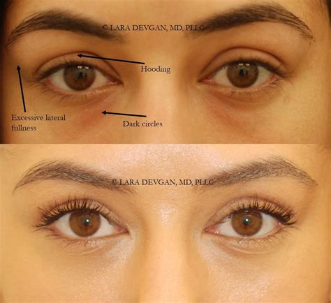 The Spectrum Of Eye Rejuvenation From Injections To Surgery — Lara